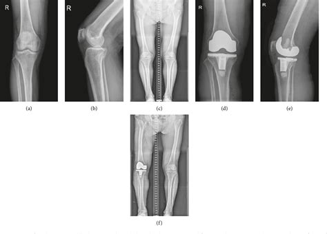 Figure 2 From A Comparative Study Of Total Knee Arthroplasty And