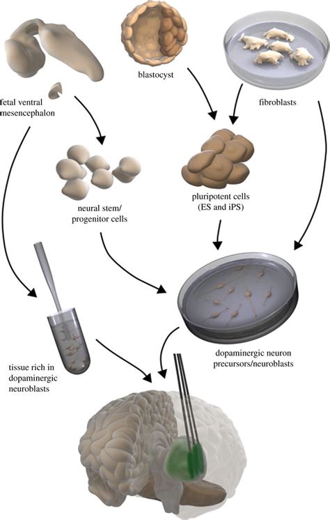 Treatment Of Parkinsons Disease Using Cell Transplantation