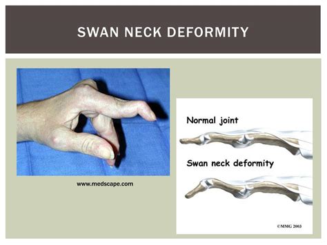 Swan Neck Deformity Psoriatic Arthritis