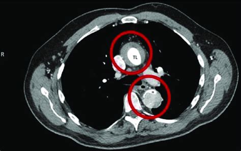 Thoracic Aortic Dissection Ct