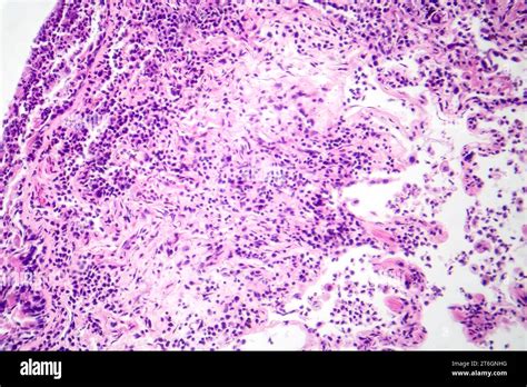 Photomicrograph Of Interstitial Pneumonia Showing Inflammation And