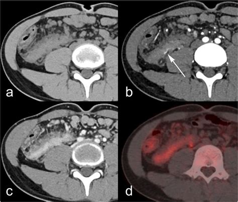 CT Imaging A Unenhanced CT Shows An Ill Defined Isodense Mass