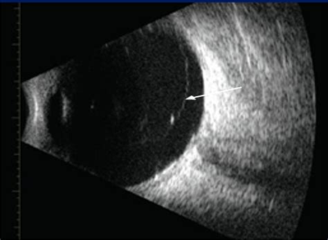 Posterior Vitreous Detachment Viewpoint