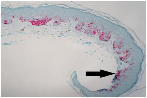 Compound Nevus With Mild Atypia