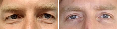 Blepharoplasty Recovery Timeline Dr Douglas Steinbrech