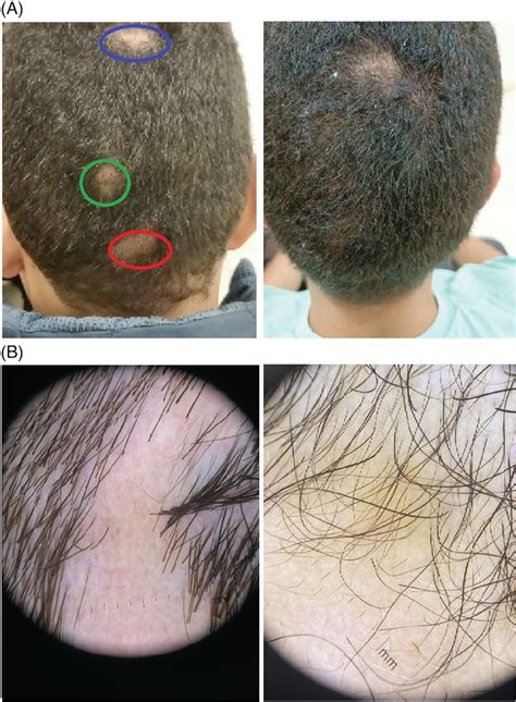 Clinical Images Showing 3 Patches Treated With Either Jessner Solution Download Scientific