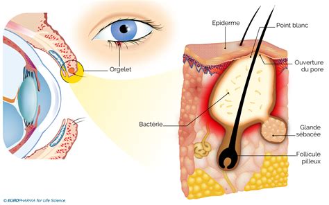 Orgelet Causes Sympt Mes Et Traitement