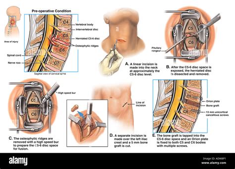 Latigazo Cervical Lesi N Cervical C Hernia Discal Cervical Con