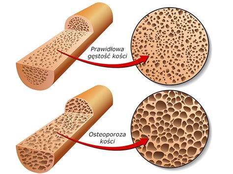 Osteoporoza jak leczyć ALFA LEK