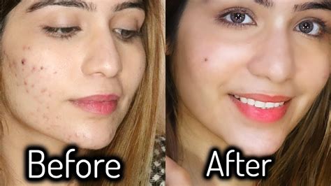 My Acne Skin Care Routine 4 Steps My Acne Story Youtube