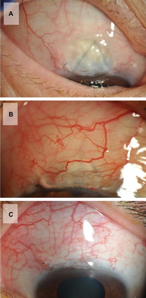 Representative Color Photos Of Blebs With Bleb Walls Of High A