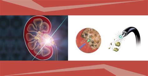 Laser Kidney Stone Surgery: What to Expect and How It Works