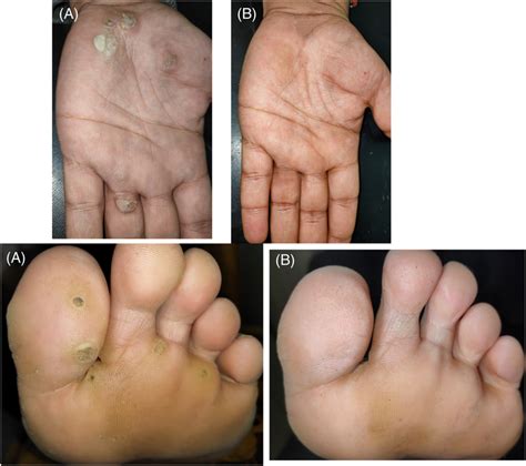 A Multiple Plantar Warts On The Left Foot And Distant Lesions On The