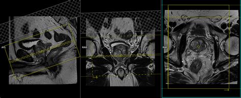 Mri Prostate Protocols Mri Prostate Cancer Multiparametric Planning