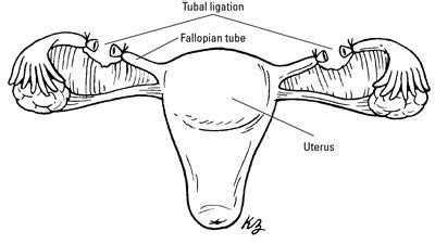 Birth Control How A Tubal Ligation Works Dummies