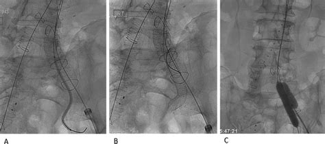 Modified Sandwich Graft Technique Employing Aorfix And Viabahn Stent