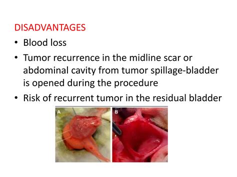 Bladder Preservation In Carcinoma Of Bladder Ppt