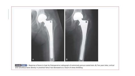 Primary Total Hip Arthroplasty Implants