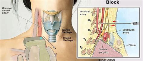 Stellate Ganglion Block Doctors in Kansas City