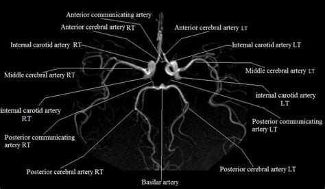 Normal Anatomy Of Cerebral Arteries On Non Invasive Ct Angiogram Download Scientific Diagram