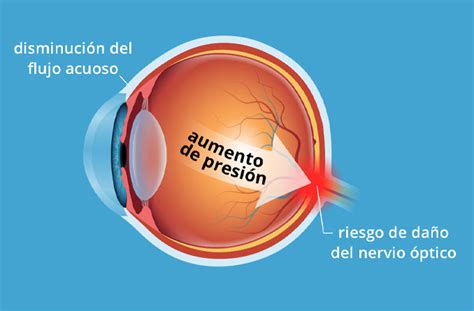 Trastornos Y Enfermedades Del Ojo Guide By Todo Sobre La Visión