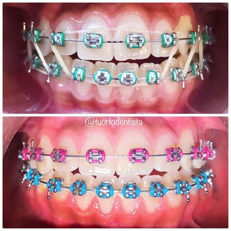 Express Your Style Unique Braces Color Trends Healthy Lifestyle Health Aesthetic Ligas