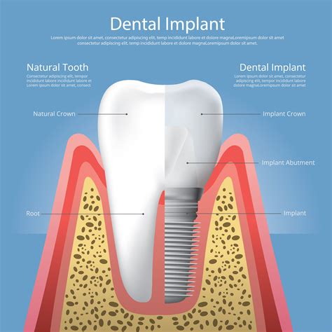 Human Teeth And Dental Implant Vector Illustration 538212 Vector Art At