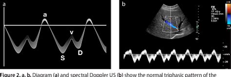 Figure 2 From Congestive Hepatopathy The Role Of The Radiologist In The Diagnosis Semantic