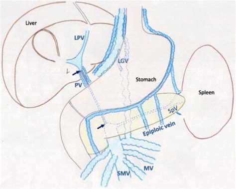 Extrahepatic Portal Vein Obstruction Dr Aniruddha Bhosale