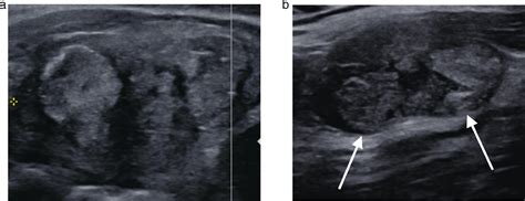 Ultrasound Guided Thyroid Biopsy Techniques In Vascular And Interventional Radiology