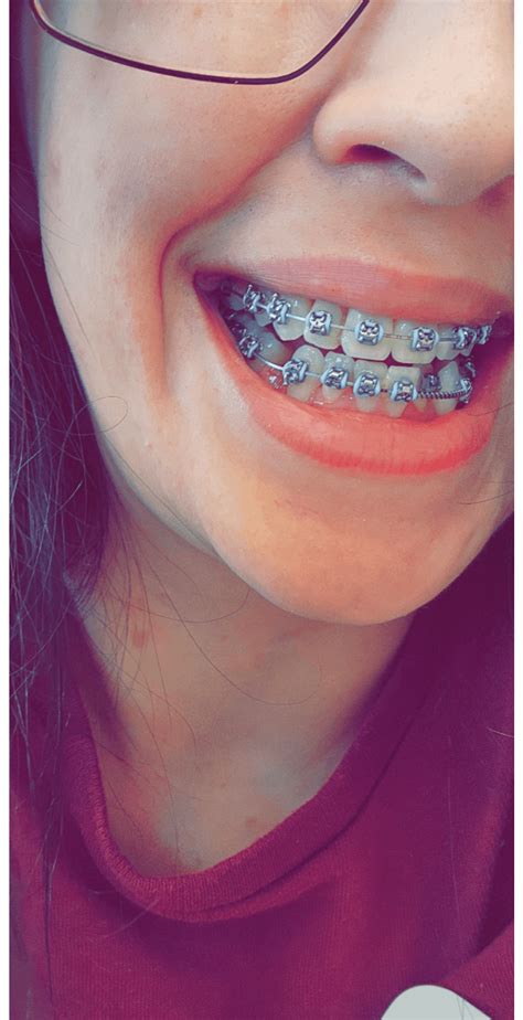 Progress 8 Months Posted Earlier About What Color To Get Next Lol Rbraces