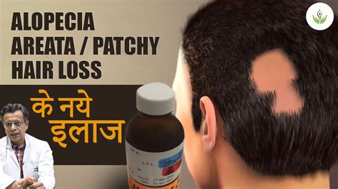 Alopecia Areata Treatment 2024 गंजेपन का असरदार इलाज Get Your Hair