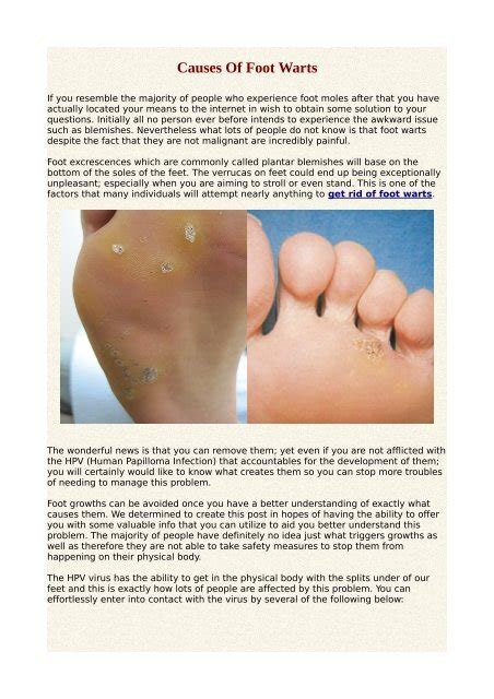 Causes Of Foot Warts.pdf