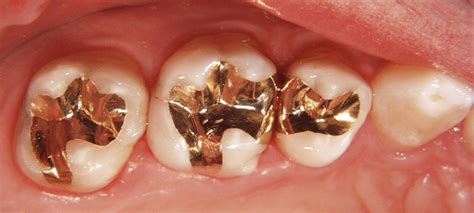 Gold Fillings Eagle Harbor Dentist