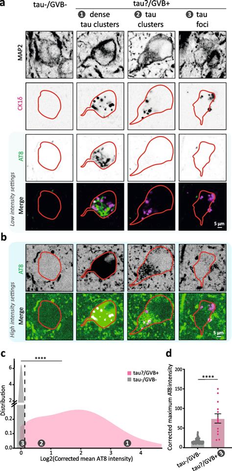 Granulovacuolar Degeneration Bodies Are Independently Induced By Tau And α Synuclein Pathology