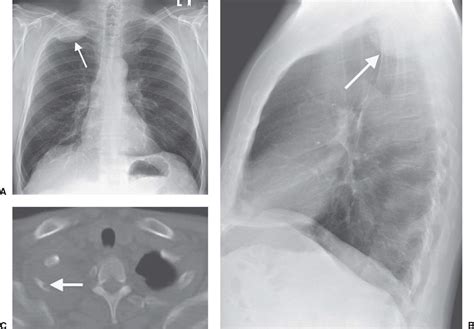 Pleura Chest Wall And Diaphragm Radiology Key