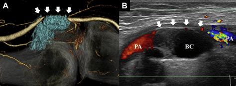 Lower Limb Ischemia Due To Popliteal Artery Compression By Baker Cyst