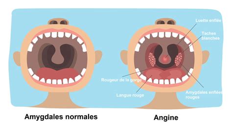 Angine virale bactérienne durée symptômes traitement