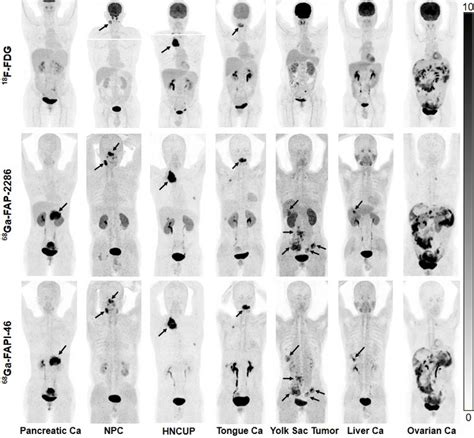 Novel Pet Radiotracer Successfully Detects Mu Eurekalert