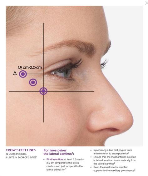 47 ideas of How Many Units Of Botox For Forehead And Crows Feet - Home ...