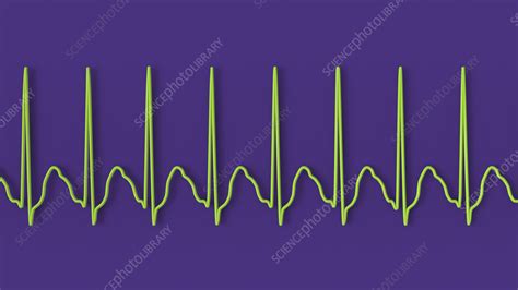 Atrial Flutter Abnormal Heartbeat Rhythm Illustration Stock Image