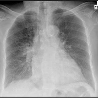 Perihilar Markings On Chest X Ray