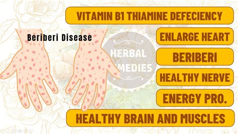 Vitamin B1 Thiamine Deficiency A Vitamin Every Diabetic Should Take