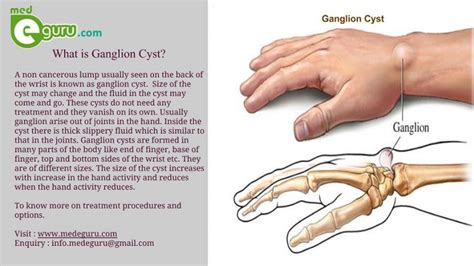 Ganglion Cyst Wrist/ Hand Expert Information DME-Direct, 51% OFF