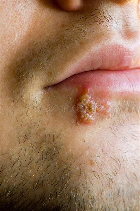 Schindeln Herpes Zoster Bedecken Hautausschlag Mit Blasen Stockbild