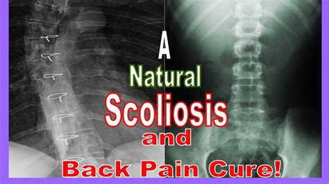 How To Cure Scoliosis Youtube