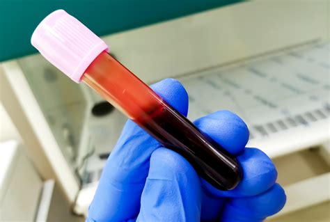 Blood Test Results For Ovarian Cancer at Isla Lampungmeiua blog