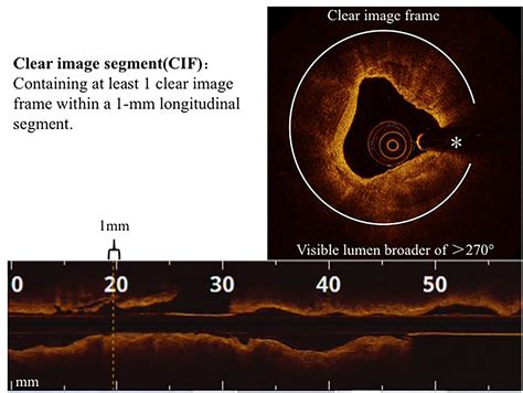 Frontiers Feasibility And Safety Of Very Low Contrast Combined Ringer