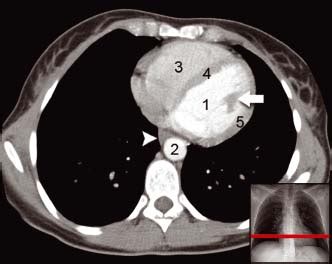 Chest CT anatomy | Radiology Key