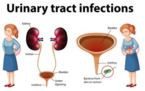 Urinary Tract Infections Utis Causes Symptoms And Treatment Coupoly